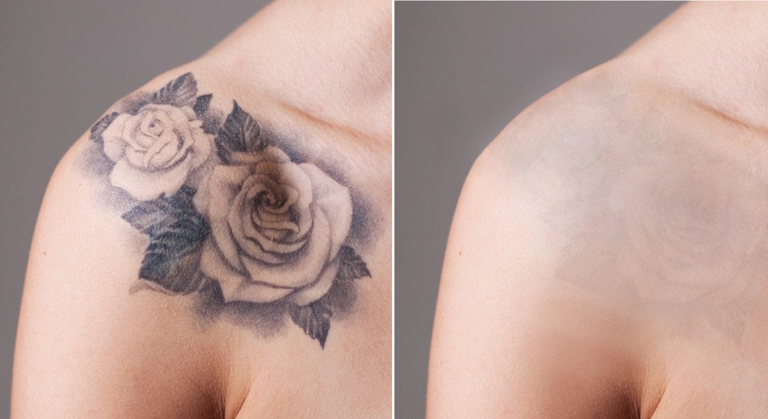 Laser tattoo removal