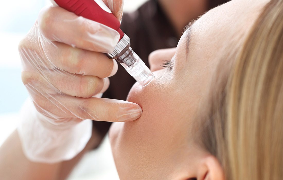 Microneedling treatment